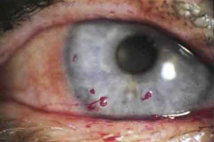 Классификация синдрома сухого глаза