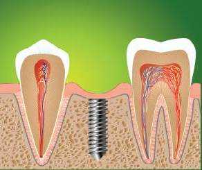 Тонкости имплантации зубов