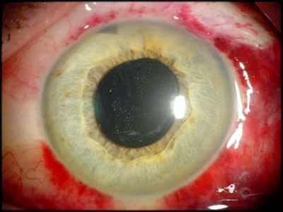 катаракта операция последствия