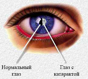 катаракта операция