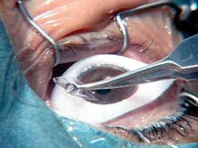 операция катаракта в перми