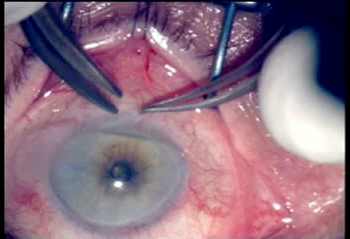 операция на глаза катаракта последствия