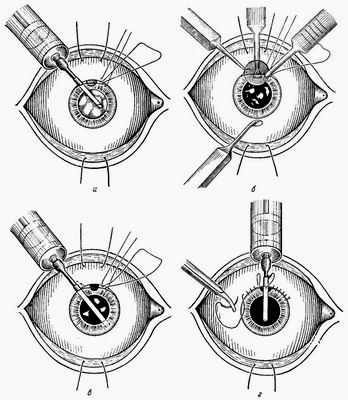 интракапсулярная экстракция катаракты