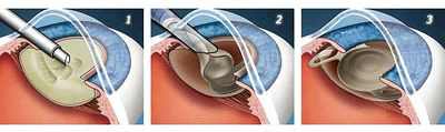 экстракция катаракты с имплантацией искусственного хрусталика