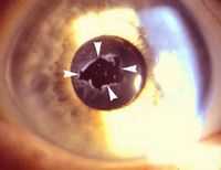 Познакомимся сами с собой. Показания и противопоказания к лазерной дисцизии вторичных катаракт. Покрасневшие глаза.