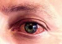 Познакомимся сами с собой. Показания и противопоказания к лазерной дисцизии вторичных катаракт. Покрасневшие глаза.