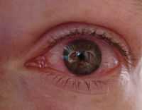 Ранняя диагностика первичной глаукомы. Раскачивания, покачивания, повороты. Коррекция зрения у детей. Распространенные глазные заболевания, причины их возникновения и лечение.