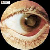 Врожденная глаукома. Врожденная и приобретенная патология хрусталика. Врожденные катаракты. Врожденная и приобретенная патология хрусталика. Вторичные катаракты.