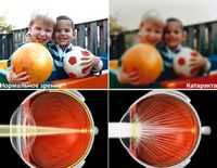 Врожденная глаукома. Врожденная и приобретенная патология хрусталика. Врожденные катаракты. Врожденная и приобретенная патология хрусталика. Вторичные катаракты.