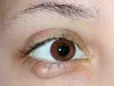 удаление катаракты лазером стоимость в ставрополе