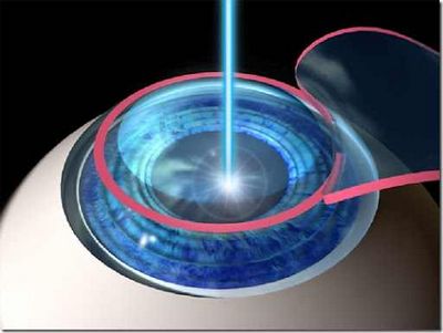 лазерная коррекция зрения операция
