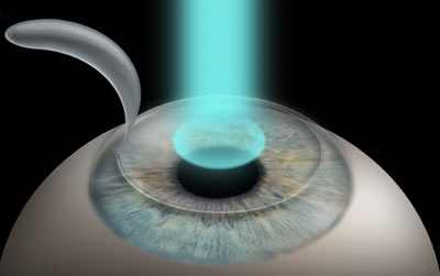 лазерная коррекция зрения плюсы и минусы