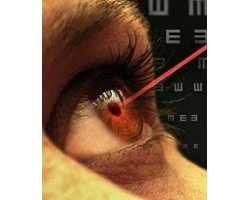 лазерная коррекция зрения побочные эффекты