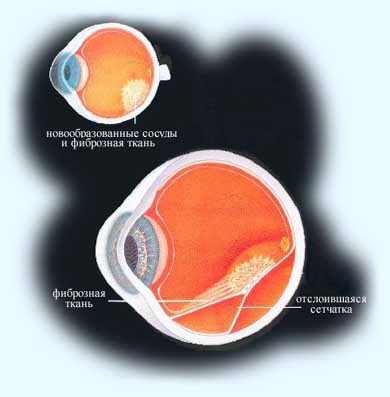 лечение катаракты в ярославле
