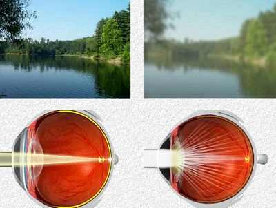 как лечить катаракту глаза в домашних условиях