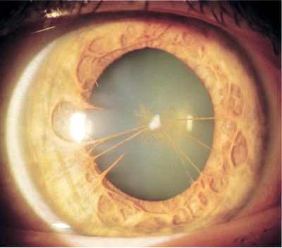 вторичная катаракта после операции форум
