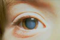 Фармакотерапия катаракты. Физзарядка для глаз. Физиологическая оптика. Рефракция. Аккомодация.