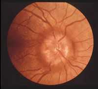 Сосудистая оптическая нейропатия. Сосудистые поражения зрительного нерва. Специальная методика восстановления зрения Occhi.
