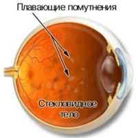 Заболевания сосудистой оболочки глаза. Заболевания стекловидного тела. Заболевания хиазмы при опухолях гипофиза.