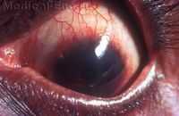 вспышки и видение радужного ореола. Вторичная глаукома. Вторичные дистрофии роговицы.
