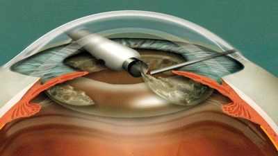 хирургия катаракты книга