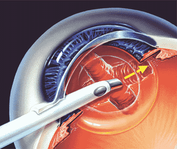 катаракта хрусталики
