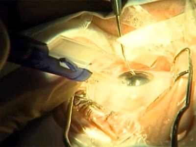 операция катаракта замена хрусталика