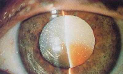 помутнение хрусталика катаракта