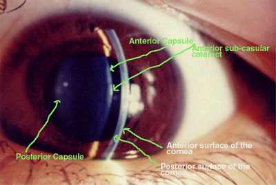 катаракта классификация