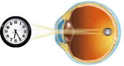 осложненная катаракта классификация