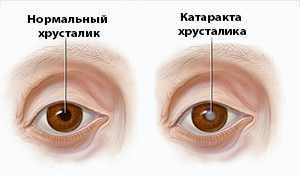 от чего появляется катаракта