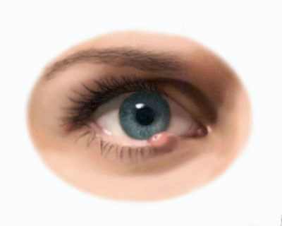 почему появляется катаракта глаза