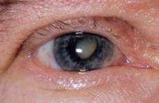 профилактика катаракты глаза