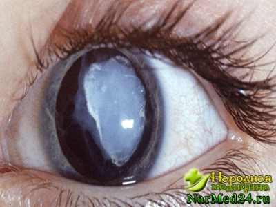 профилактика катаракты глаза