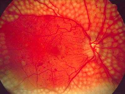 Роль иммунитета в лечении ретинопатии