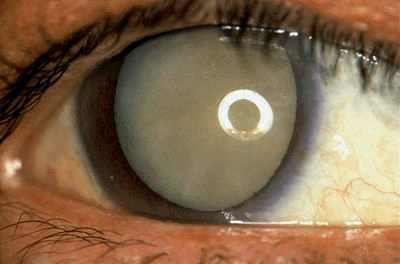 отек глаза после операции катаракты