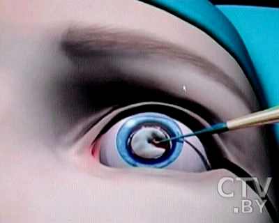 новые способы лечения катаракты