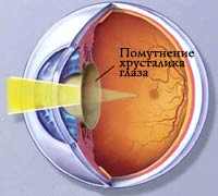 катаракта операция нижний новгород больница 35