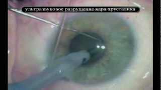 бесплатное удаление катаракты в москве