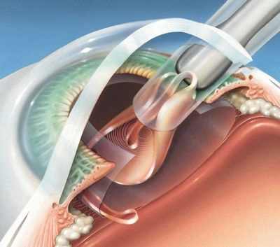 факоэмульсификация катаракты противопоказания