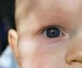 врожденная катаракта у детей инвалидность