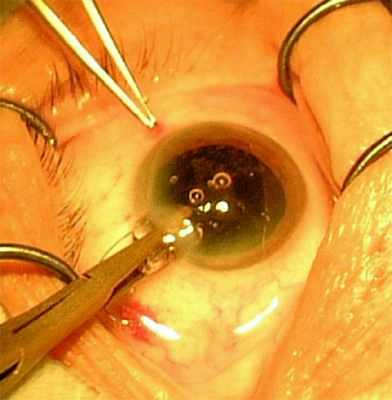 бесплатная операция по удалению катаракты в москве