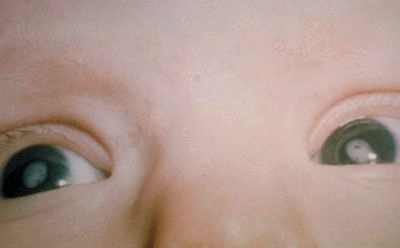 врожденная катаракта обоих глаз